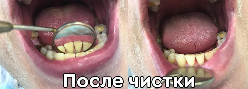 Гигиена и отбеливание — материалы клиники